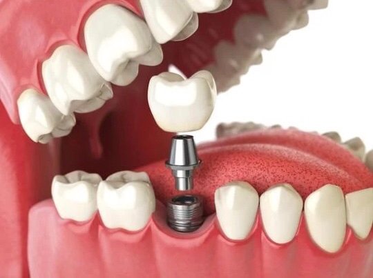 Imagem de colocação de pino de implante dentário